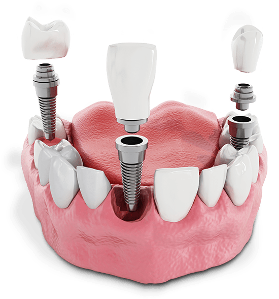Dental Implants Model Rendering