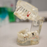 Dental Implant Options for Every Smile: Find the Right Fit at Smile! Dental Center