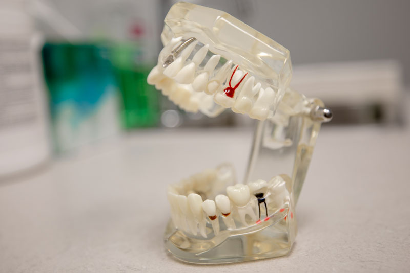 Dental Implant Options for Every Smile: Find the Right Fit at Smile! Dental Center