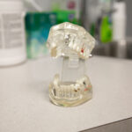 What to Expect During the Dental Implant Process at Smile! Dental Center