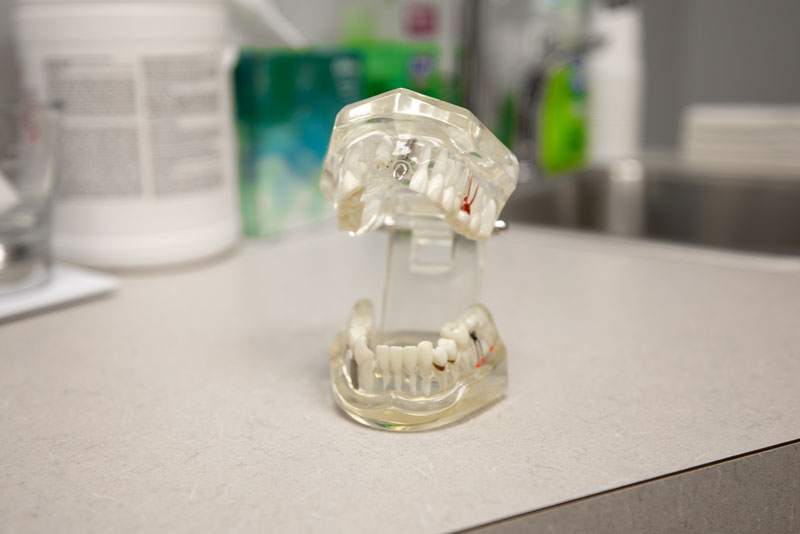 What to Expect During the Dental Implant Process at Smile! Dental Center